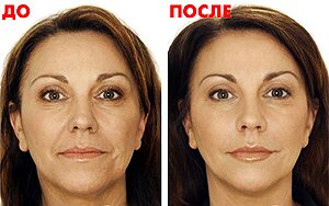 Результат после 1-й процедуры